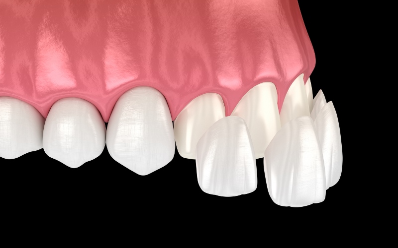 3D illustration of a dental veneer of front teeth in Trenton, MI