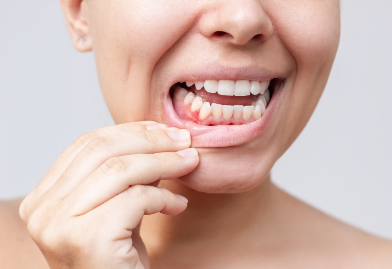 Close-up of inflamed gums and teeth in Trenton, MI